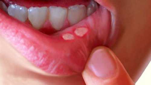 7 натуральних ліків, що допоможуь позбутись язв у роті | INFBusiness