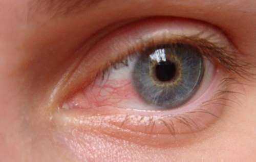Червоні очі: як позбутися почервоніння за допомогою простих домашніх засобів | INFBusiness