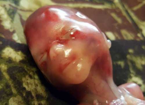 Фото, доводить, що аборт дорівнює вбивству | INFBusiness