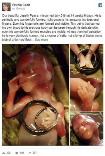 Фото, доводить, що аборт дорівнює вбивству | INFBusiness
