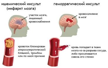 У разі інсульту врятує життя звичайна ГОЛКА! Це потрібно знати всім! | INFBusiness