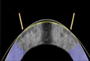 Альтернатива LASIK? Ранні випробування нового безлазерного лікування очей показують багатообіцяючі результати | INFBusiness
