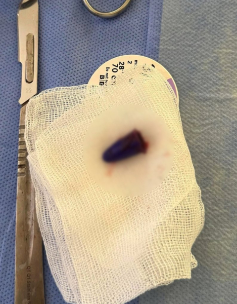 Залишилося кілька хвилин: у Львові врятували школяра, який вдихнув… ковпачок від ручки | INFBusiness