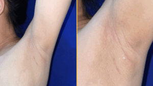 Діагностична дилема: Витік молока з-під пахв жінки виявив «ектопічні груди» | INFBusiness