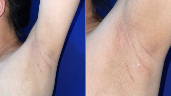 Діагностична дилема: Витік молока з-під пахв жінки виявив «ектопічні груди»