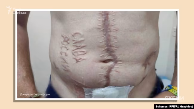 Сліпа лють: хто випалив "слава росії" на тілі полоненого? 6