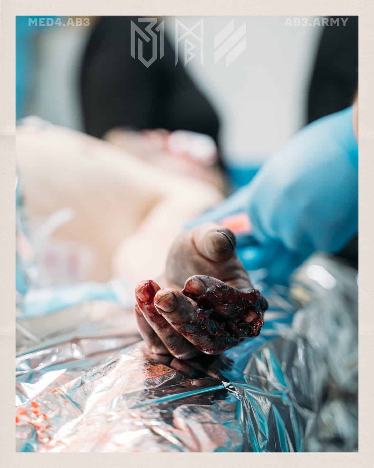 Регіонарна анестезія на стабілізаційних пунктах: переваги та виклики впровадження 3